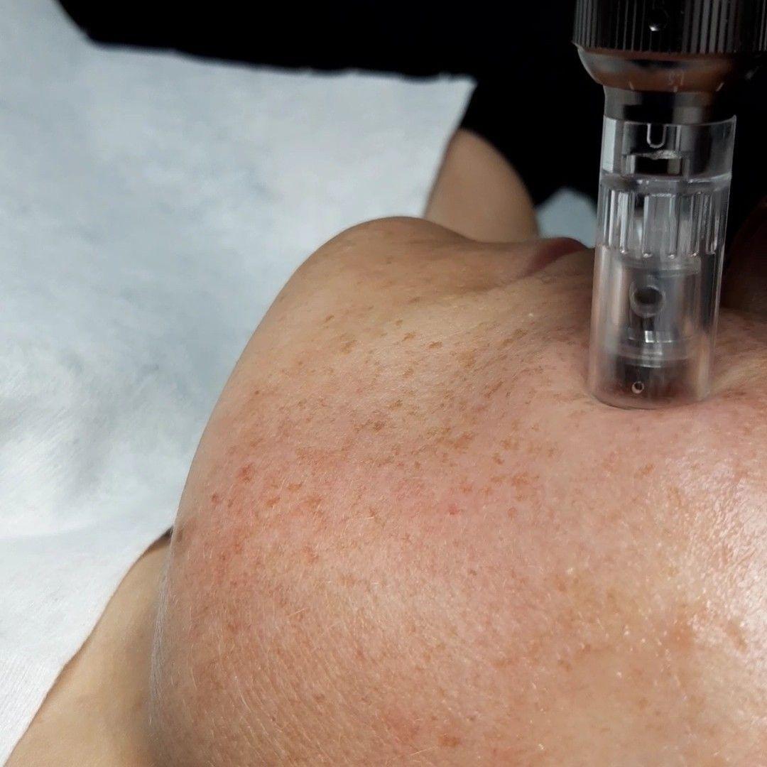 Read more about the article Mezoterapia Mikroigłowa